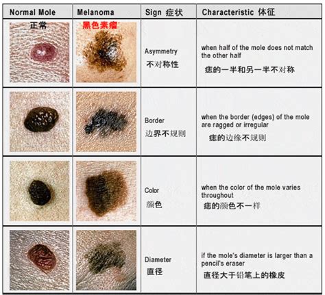 腋下旁邊有痣|痣也可能会癌变！长在 3 个地方要注意